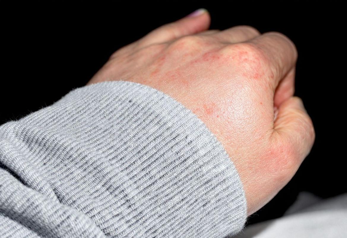 Brulure epilation laser maillot : que faire en cas de brûlure ?